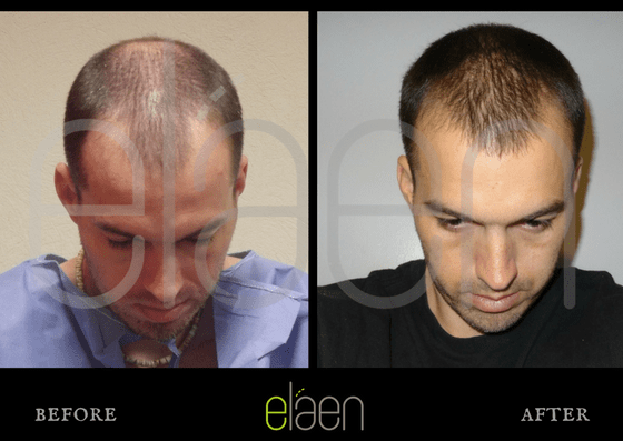Hair Transplant Mexico Surgery Before and After | Expert Surgeon