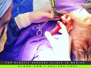 Facelift Mexico Tisseel Glue